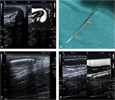 Case Report: A case of rapamycin-eluting stent for the treatment of refractory stenosis of arteriovenous fistula stenosis
